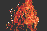 bad lung