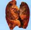 smokers lung